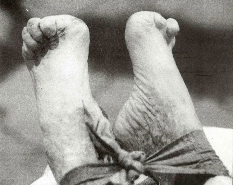Los dedos de los pies mutulados, clave para su identifiación (ABC Color)