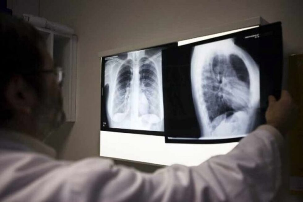 En 9 meses Tarija reportó 175 casos de tuberculosis