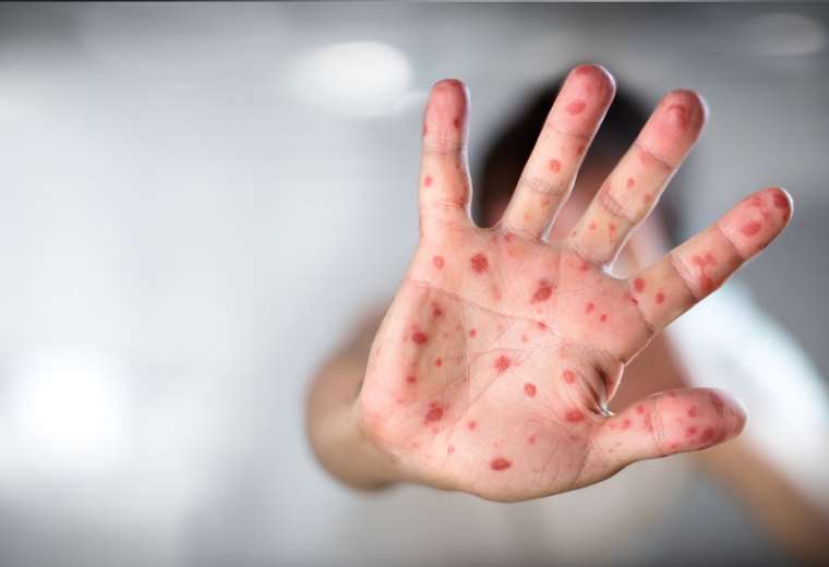 Alerta de sarampión: 1.700 vacunas gratuitas fueron aplicadas en 'zonas rojas' | EL DEBER