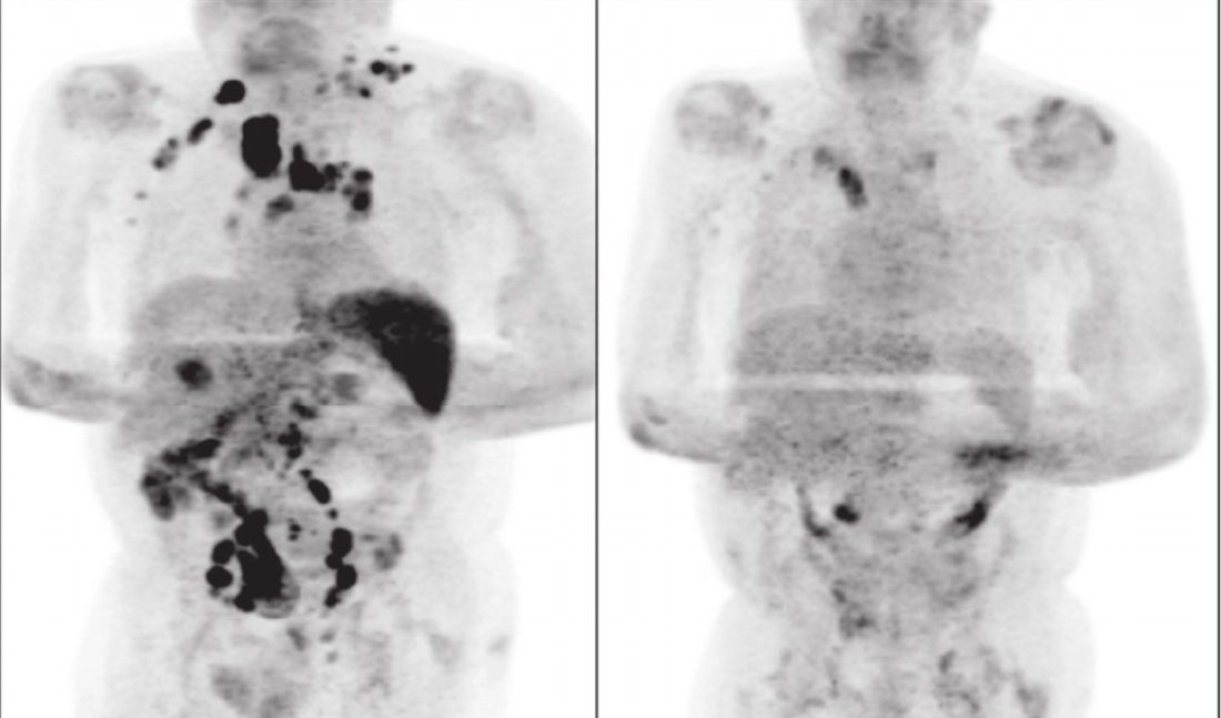 Antes y después. Imágenes tomográficas del paciente que se curó de un linfoma de Hodgkin tras contraer COVID-19. Foto: Challenor et al