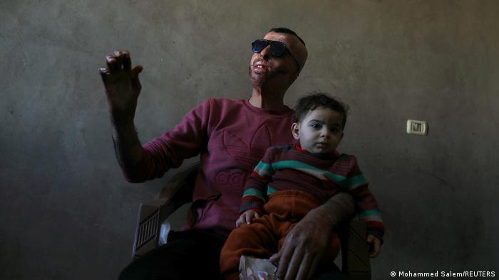 Palästina Brandopfer aus Gaza erhalten 3D-gedruckte Gesichtsmasken