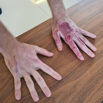 Una imagen de cómo le quedaron las manos quemadas a Grosjean tras el accidente