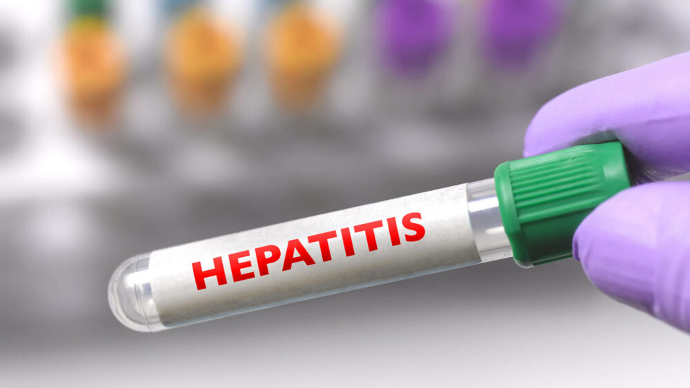 La hepatitis, una inflamación del hígado, puede ser transmitida por cinco diferentes tipos de virus, A, B, C, D y E (Getty Images)