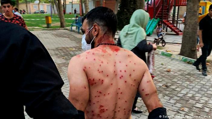 Un hombre con heridas de decenas perdigones causadas durante una de las protestas en Irán