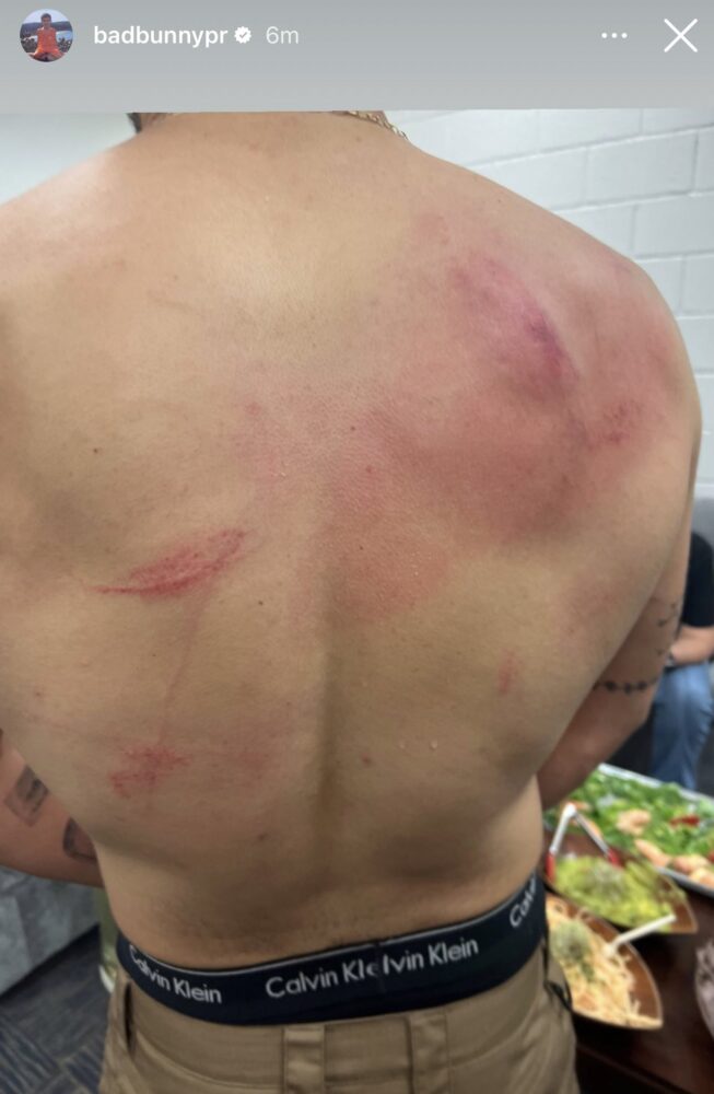 Bad Bunny compartió en redes las heridas que le causó su lucha con Damian PriestFoto: Instagram/Bad Bunny