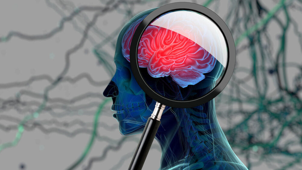 Los investigadores de EE.UU. identificaron una zona del cerebro asociada al dolor crónico y biomarcadores objetivos de dolor crónico en pacientes individuales. Los resultados se podrían usar para evaluar el procedimiento de la estimulación cerebral/ (Getty)