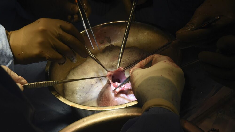 Cirujanos realizan un trasplante de corazón de cerdo a Lawrence Faucette en el hospital de la facultad en Baltimore, Maryland, en septiembre de 2023 (AP)