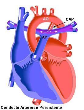 Conducto Arterioso Persistente | Congenital Heart Disease - Cove Point Foundation | Johns Hopkins Children's Hospital