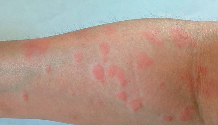 Lupus eritematoso sistémico: síntomas, diagnóstico, pronóstico