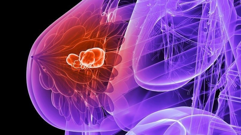 Ribociclib previene la recurrencia también en el cáncer de mama temprano
