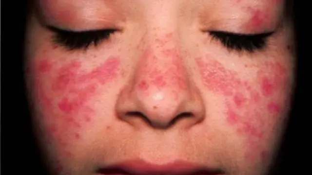 Guía para pacientes con lupus eritematoso: qué es, causas, síntomas y tratamiento