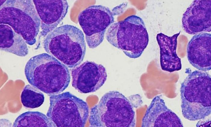 La leucemia mieloide crónica: el paradigma de la importancia de la investigación - Fundación Josep Carreras contra la leucemia
