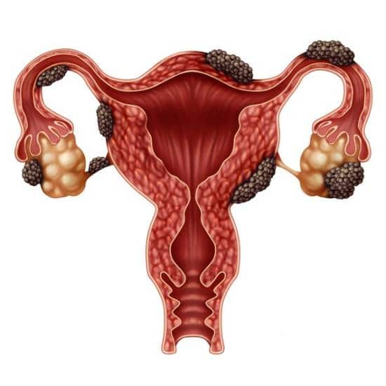Hablemos de la endometriosis - Centro Médico Monjitas