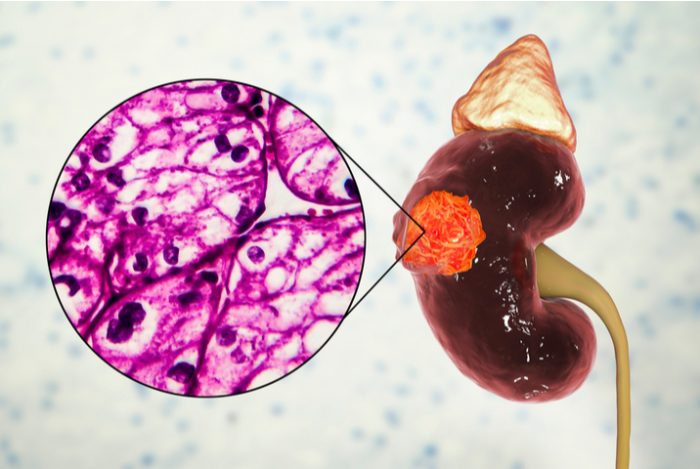 Nuevo tratamiento de primera línea para pacientes con carcinoma de células renales avanzado - El médico interactivo