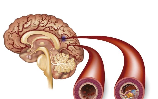 ACV isquémico o infarto cerebral: síntomas – Bupa