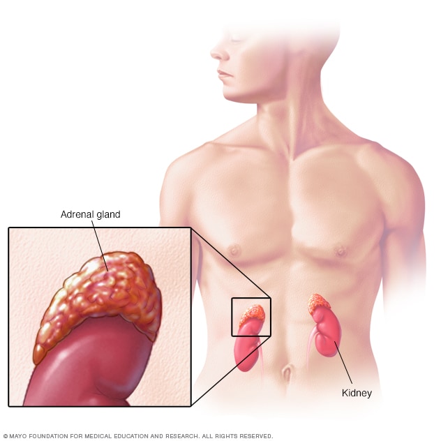 Hiperplasia suprarrenal congénita - Síntomas y causas - Mayo Clinic