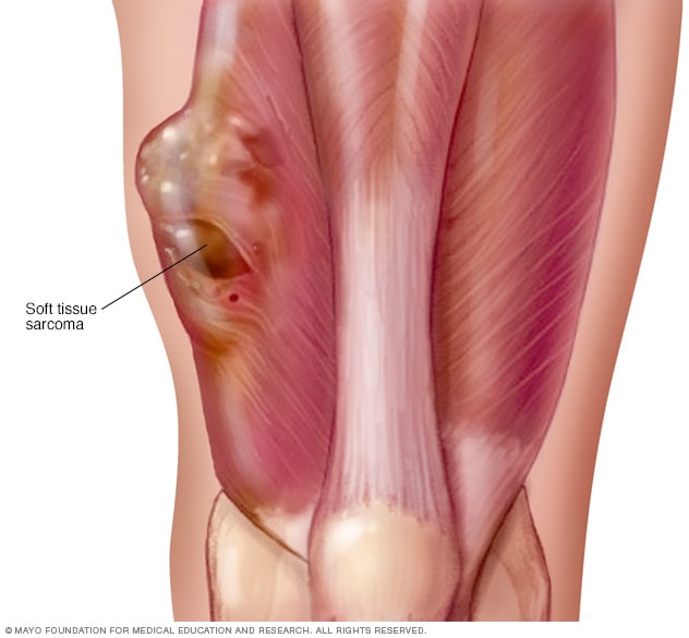 Sarcoma de tejido blando - Síntomas y causas - Mayo Clinic