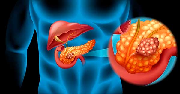 Quistes pancreáticos, ¿cuáles son los tipos más comunes que existen?