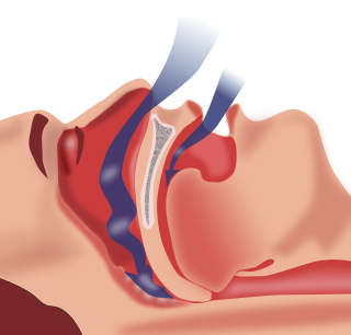 Síndrome de apnea-hipopnea durante el sueño - Wikipedia, la enciclopedia libre