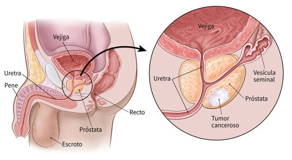 Pruebas de detección para el cáncer de próstata