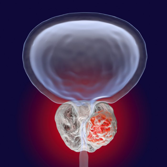 La detección del cáncer de próstata con resonancia magnética es menos rentable que la PSA - El médico interactivo