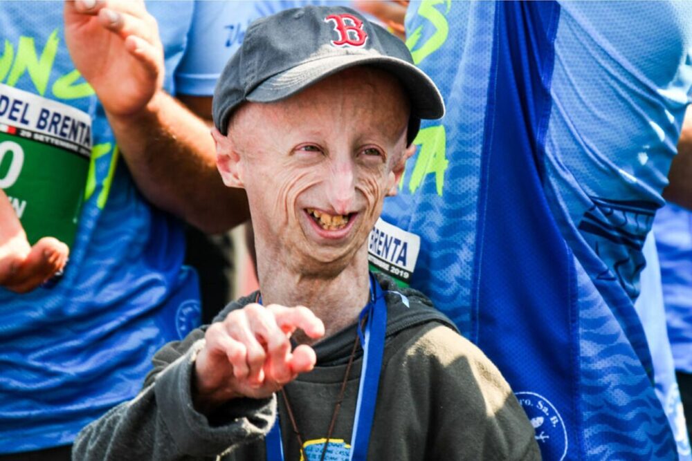 Muere a los 28 años Sammy Basso, el paciente con progeria más longevo de la historia