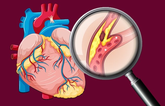 Dislipidemia: qué es, síntomas y tratamiento | Top Doctors