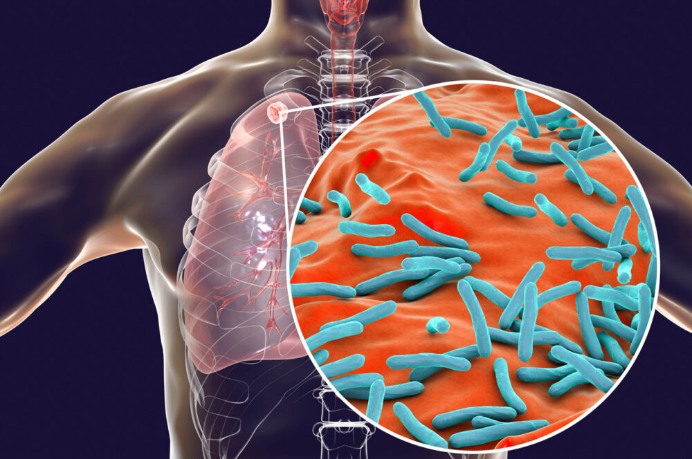 TUBERCULOSIS MULTIRRESISTENTE