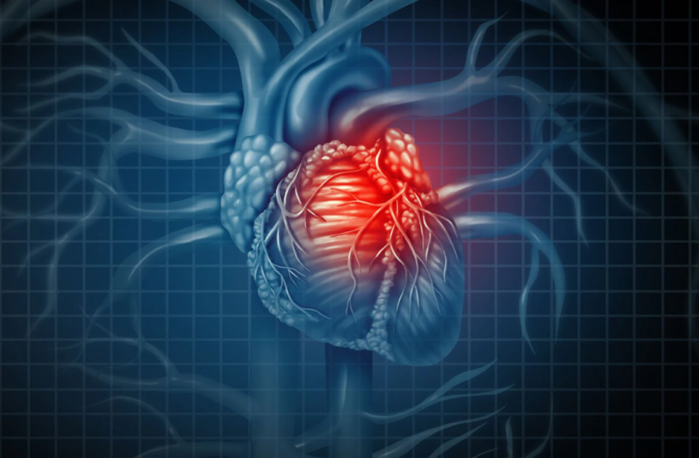 La colchicina reduce las complicaciones cardiovasculares tras un infarto de miocardio - COFA