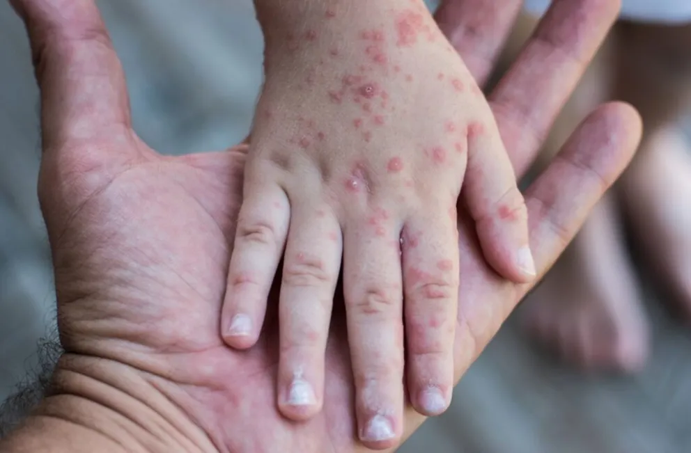 Sarampión. Foto: Ministerio de Salud