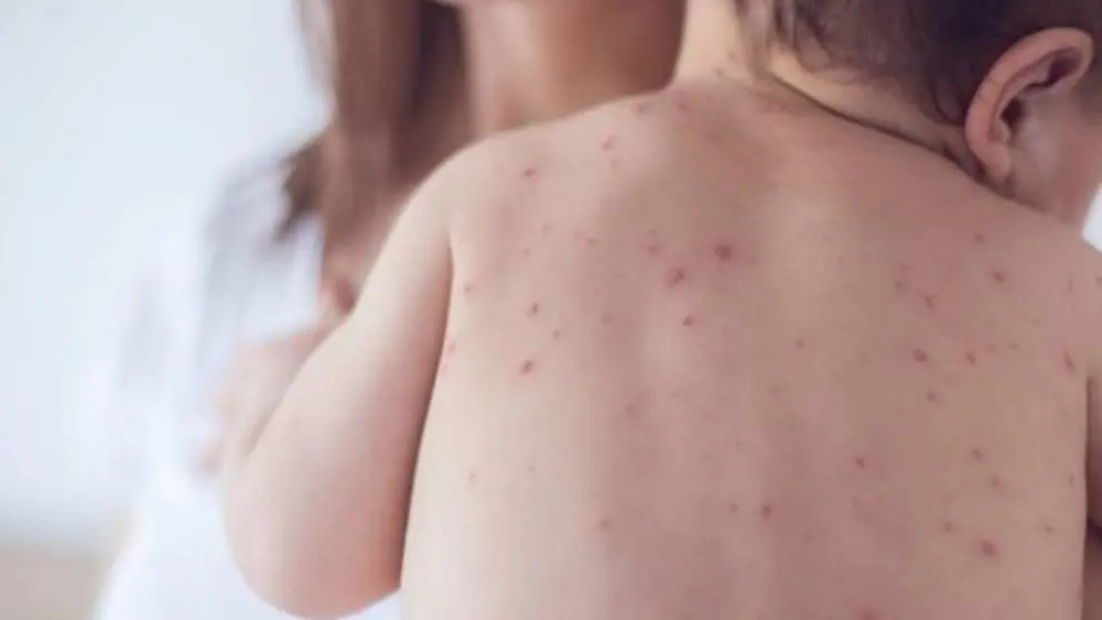 Niños con sarampión en Beni se recuperan favorablemente