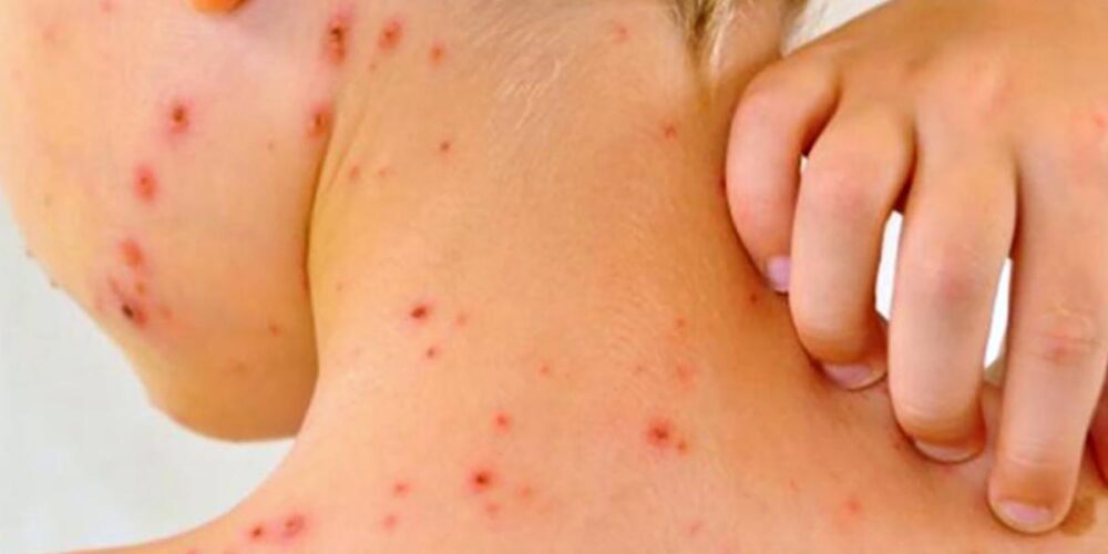 Sarampión, el virus que regresa